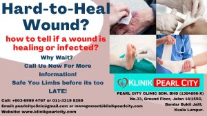 Read more about the article Hard-to-Heal Wounds