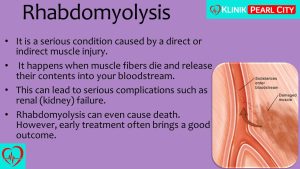 Read more about the article Muscle Pain And Dark Urine? It Could Be Rhabdomyolysis!